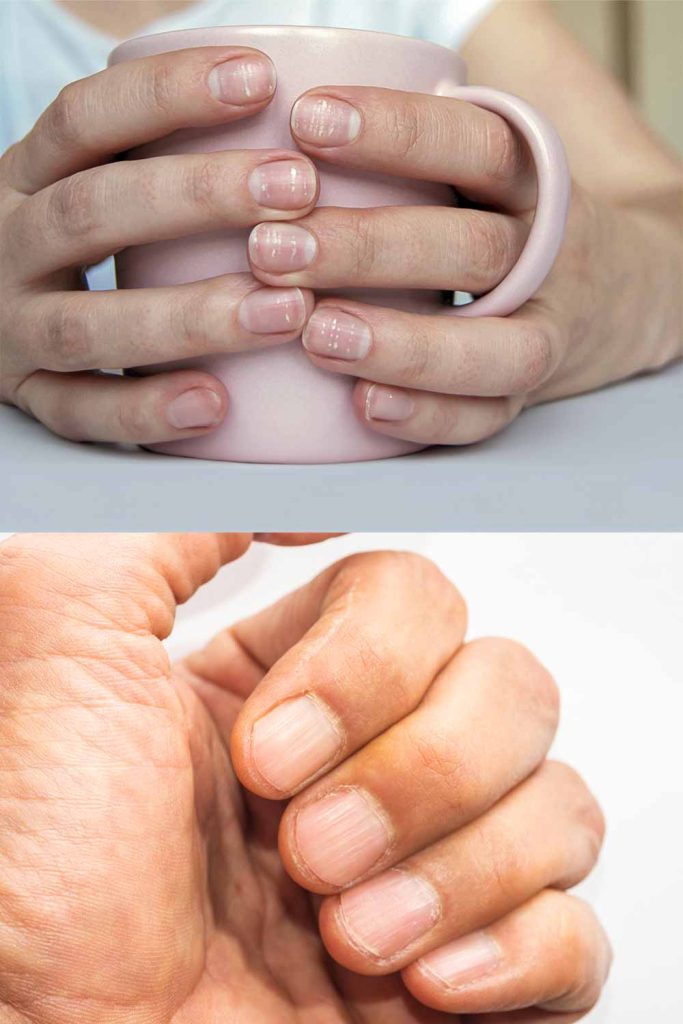 What Your Fingernails Say About Your Health - GreenSmoothieGirl